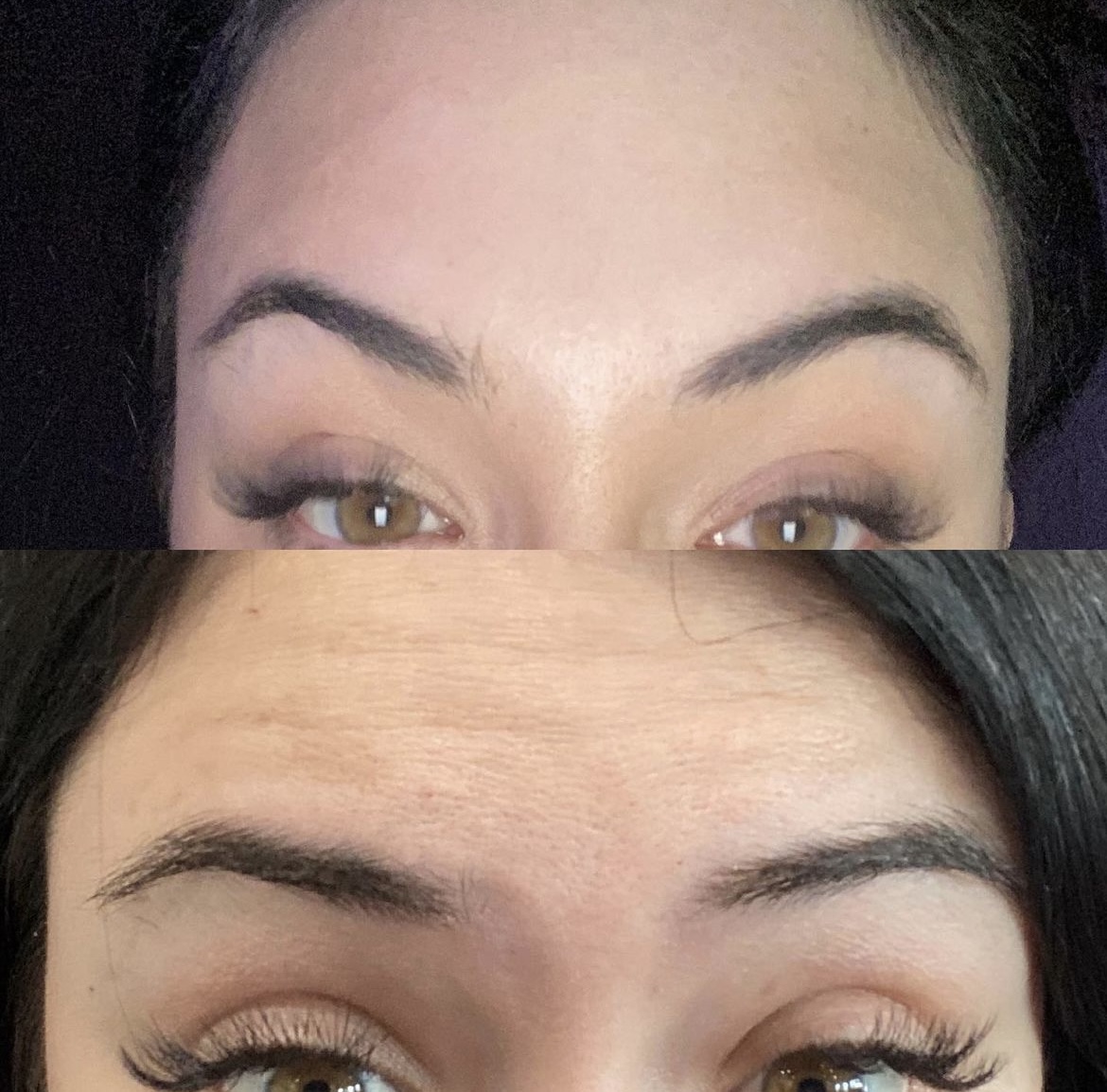 Before and after Botox result photo 1