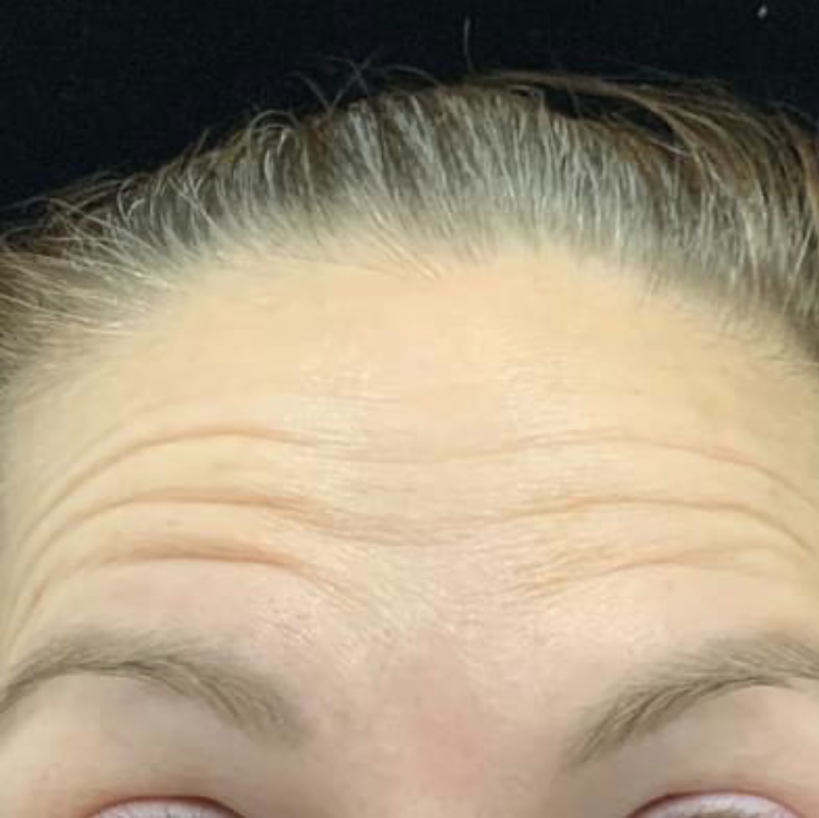Before and after Botox result photo 2