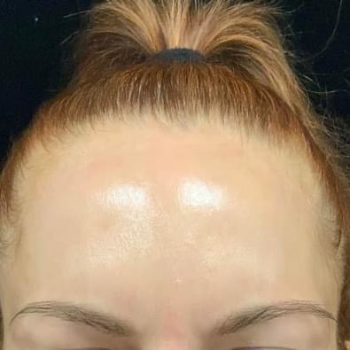 Before and after Botox result photo 3