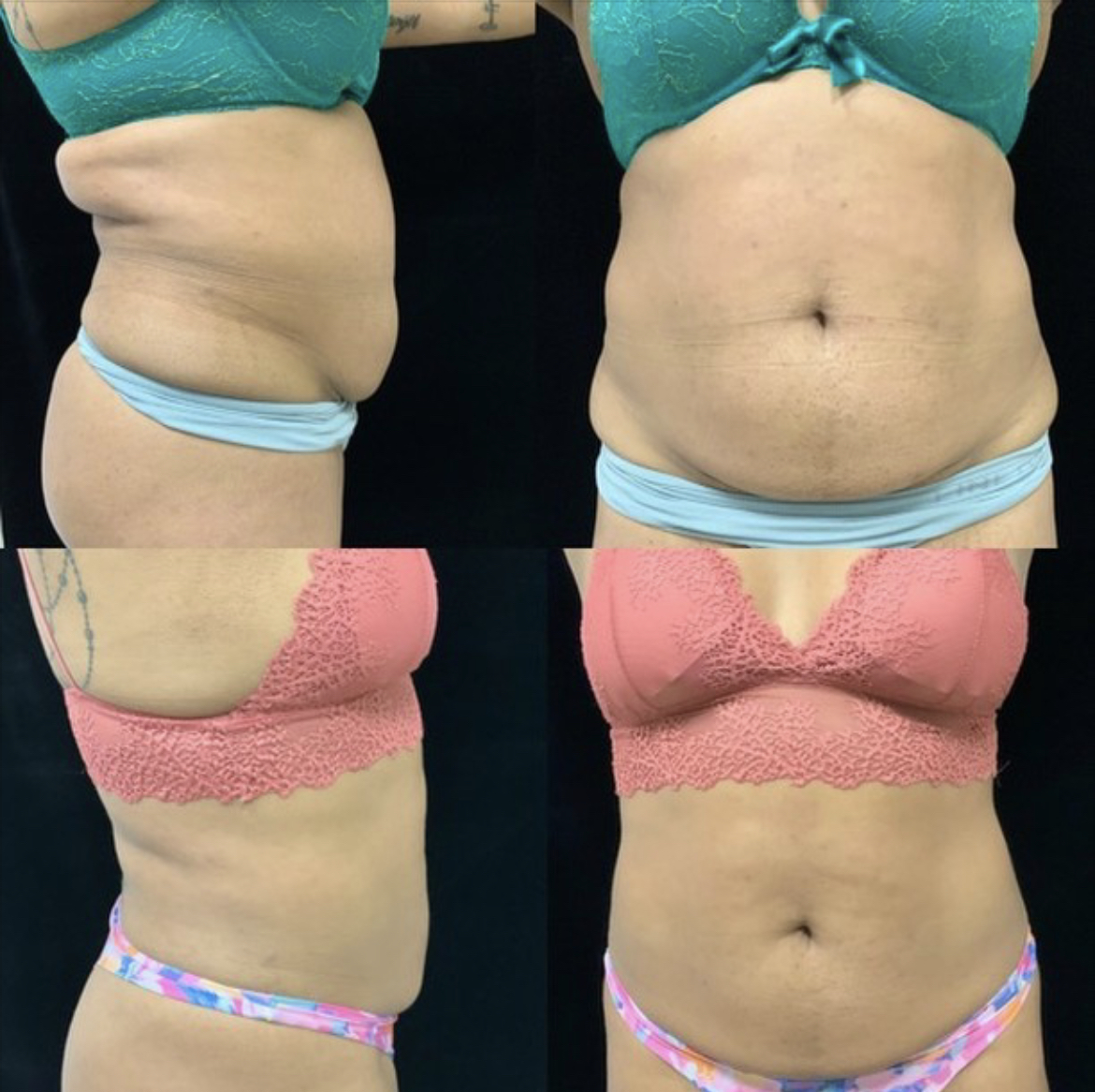 truSculpt iD before and after contouring results view 2