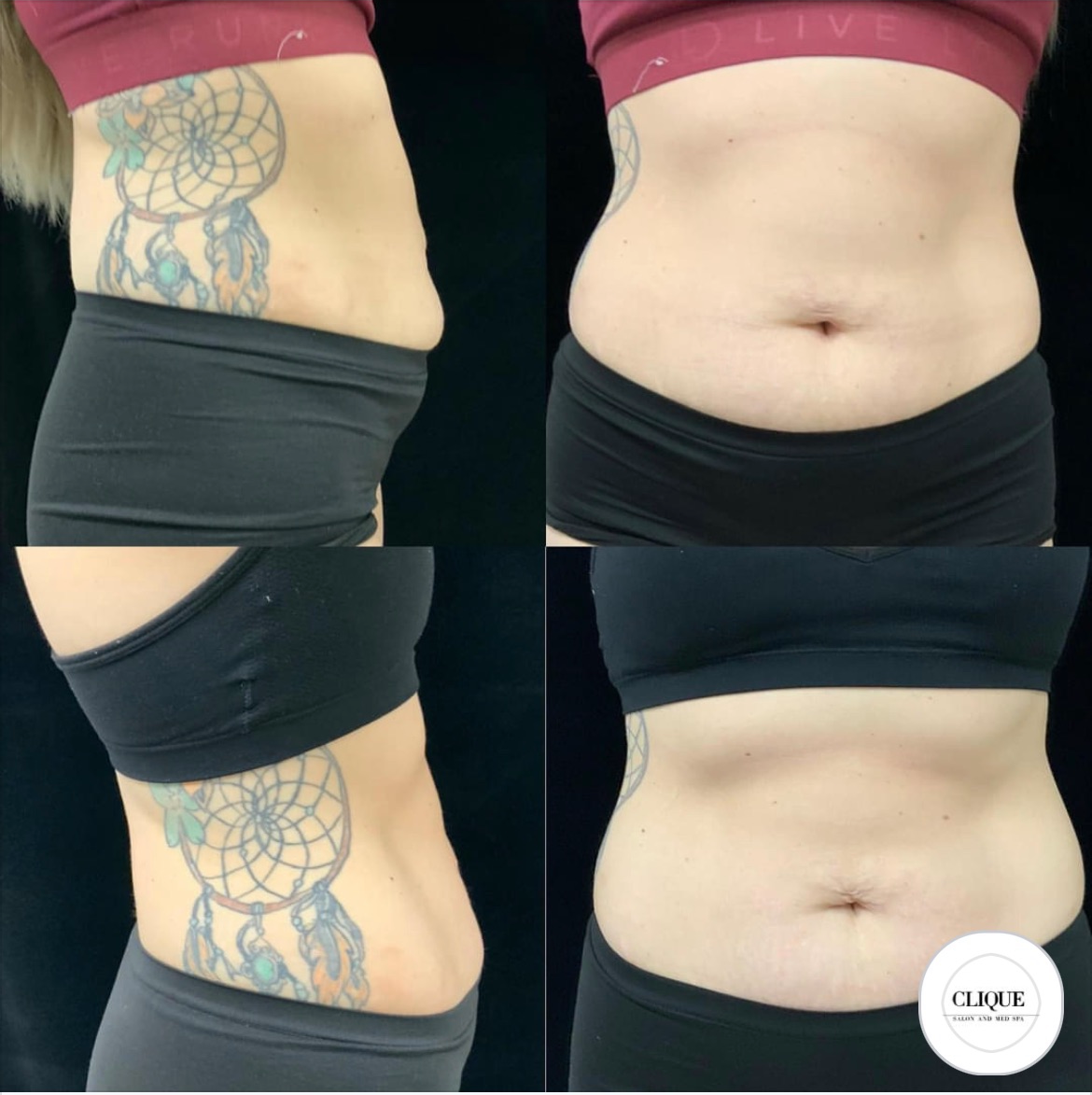 truSculpt iD before and after contouring results view 1