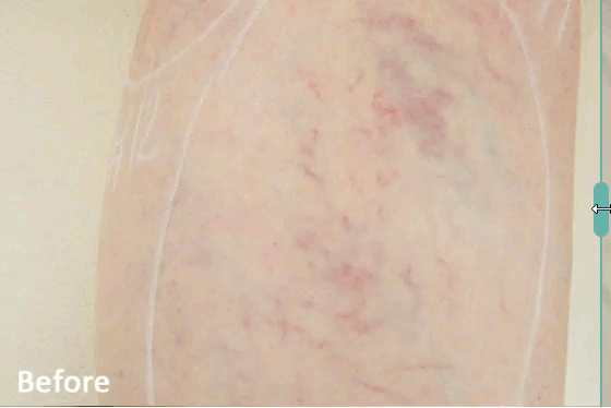 VasculazeMAX Spider Vein Removal