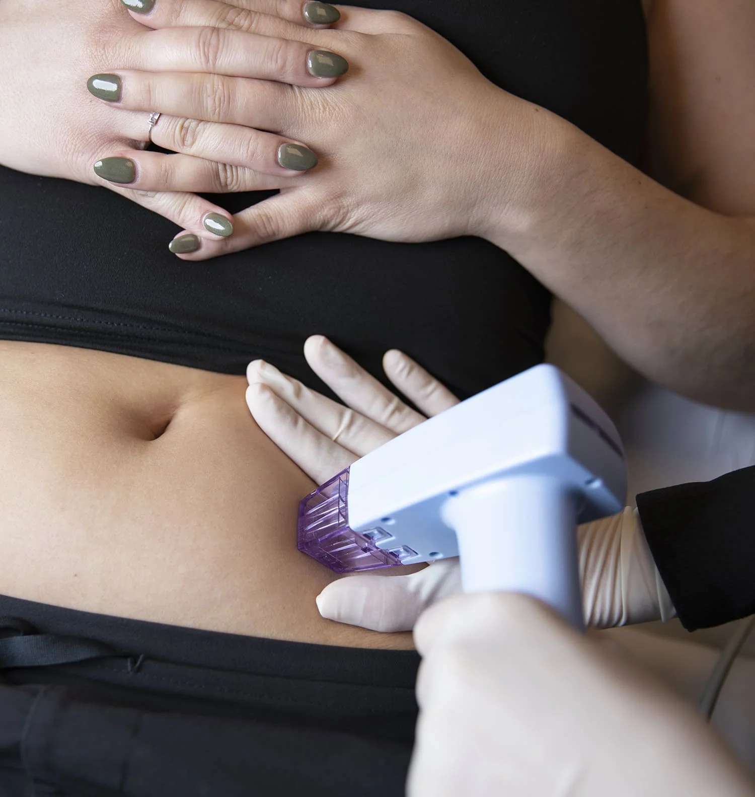 Morpheus8 Body treatment device and procedure
