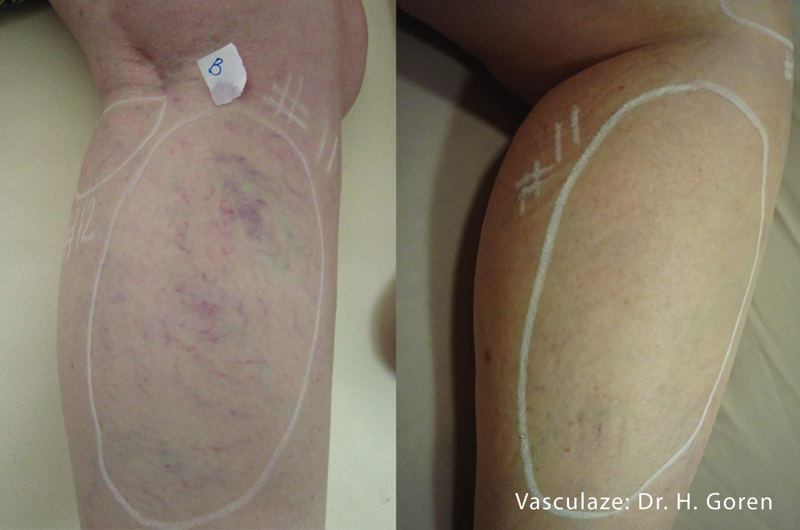 VasculazeMAX before and after image 1