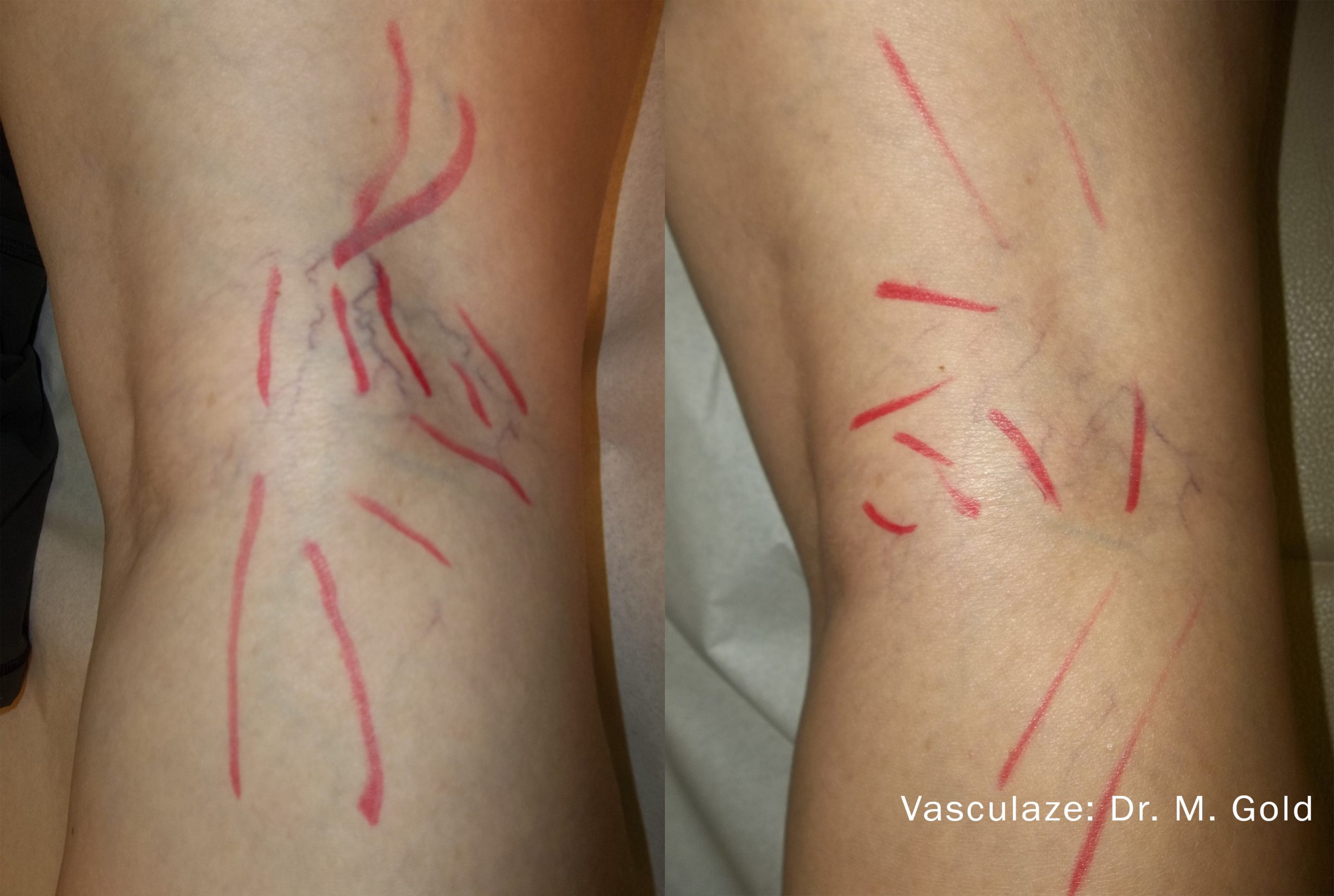 VasculazeMAX before and after image 2