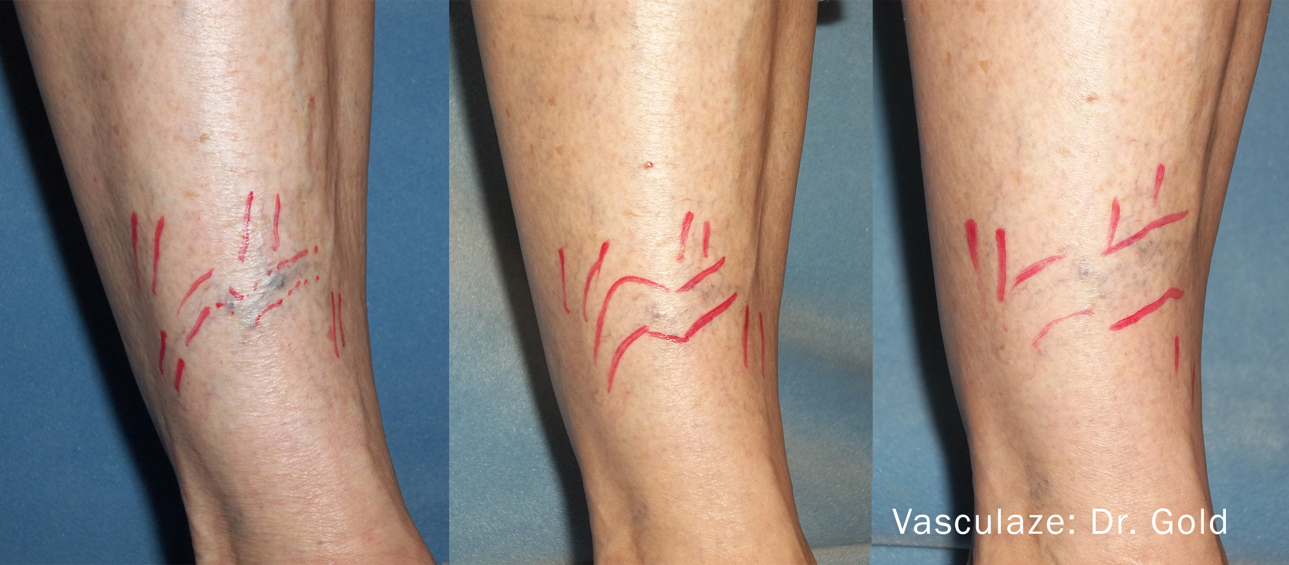 VasculazeMAX vascular treatment close-up result