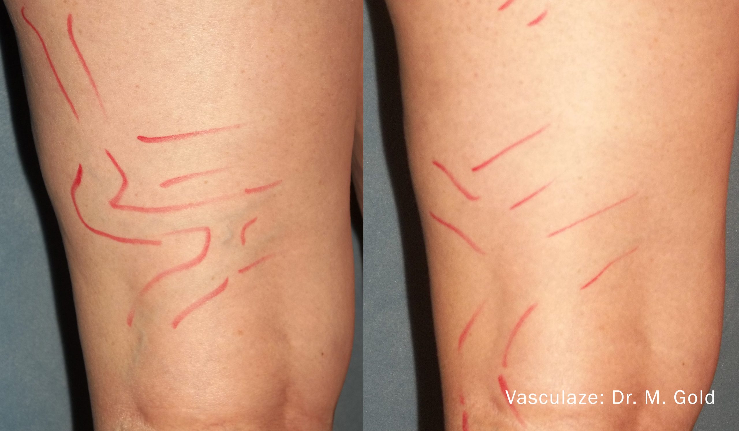 VasculazeMAX before and after image 3